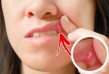 4 وصفات طبيعية للتخلص من قروح الفم