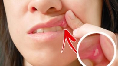 4 وصفات طبيعية للتخلص من قروح الفم