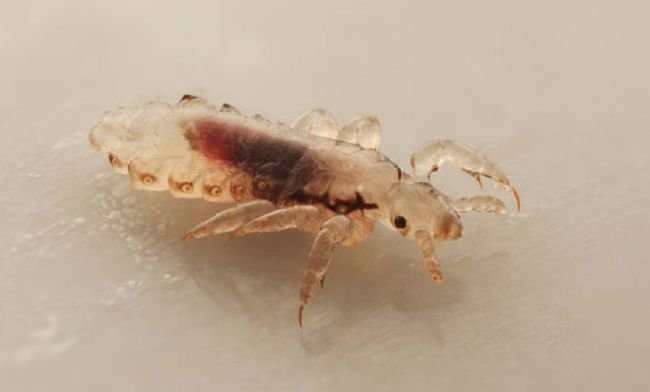 وصفات طبيعية فعالة للقضاء على القمل