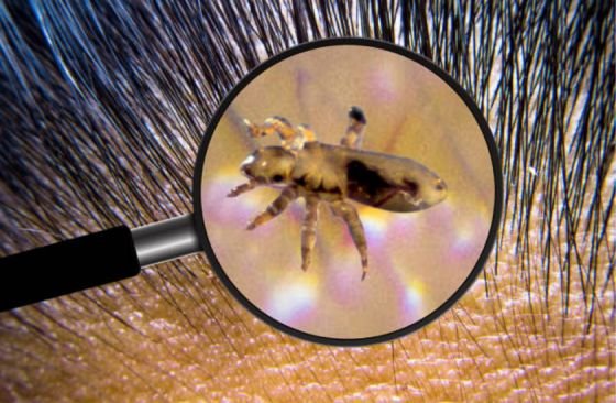 وصفات طبيعية فعالة للقضاء على القمل